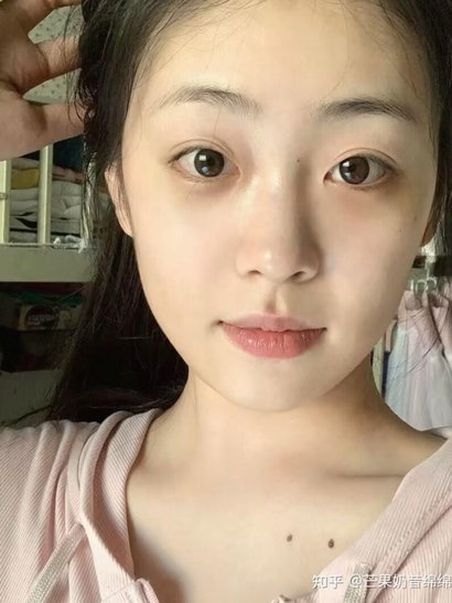 有些人确实形成黑圈了。