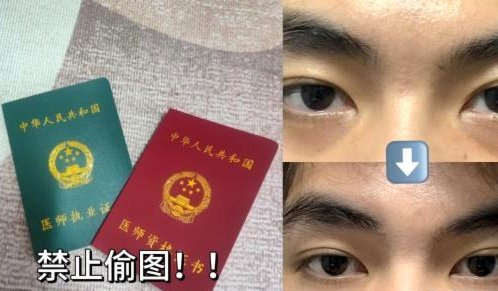 有些人确实形成黑圈了。